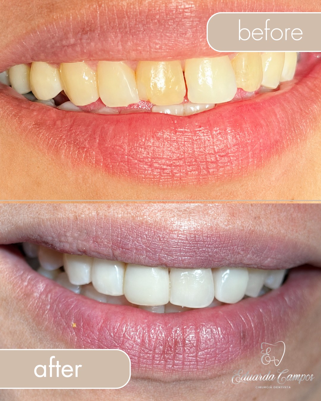 Resultado antes e depois de tratamento odontológico